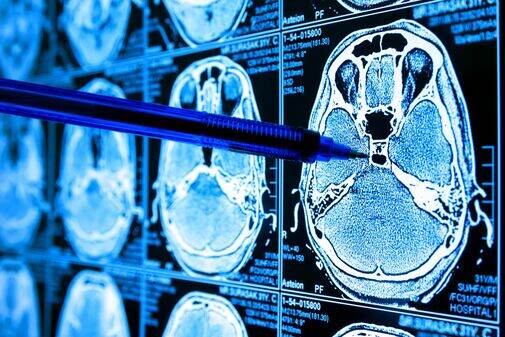 AI Cancer Diagnosis